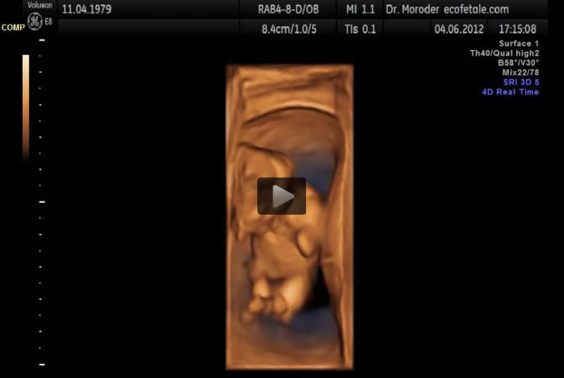 3D Ultrasound