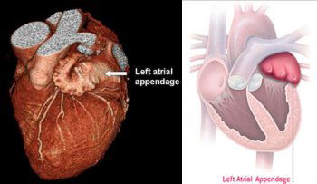 Left Atrial Appendage