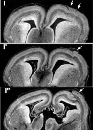 brain-folding