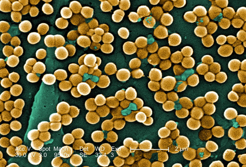 MRSA Cutaneous abscess MRSA staphylococcus aureus