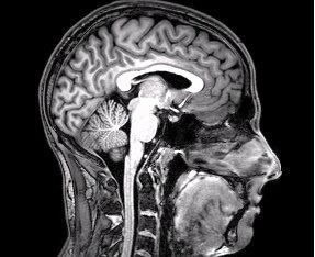 MRI Brain Scan