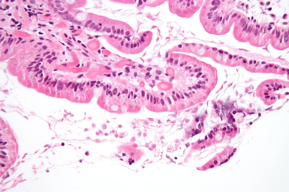 Sensul giardiasis în malajalam. Papillary urothelial lesion. Diagnostic Pathology: Cytopathology
