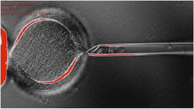 enucleation