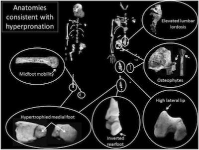 sediba-hyperpronation