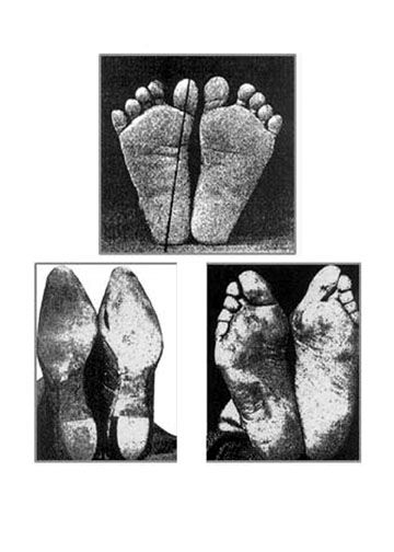 Hammer toe: MedlinePlus Medical Encyclopedia Image