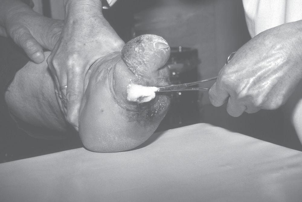 Cleaning the Deformed Foot of a Person Suffering from Leprosy