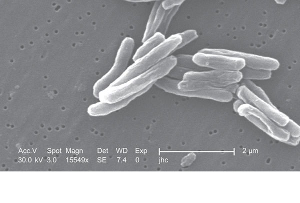 Tuberculosis