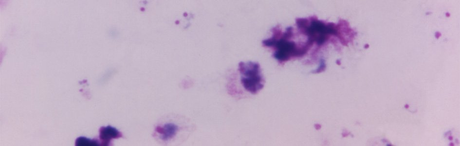 Photomicrograph of a Giemsa stained, thick film blood smear