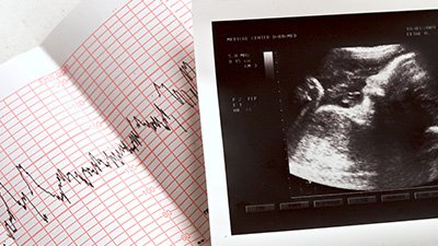 Fetal Heartbeat—A “Manufactured Sound”?