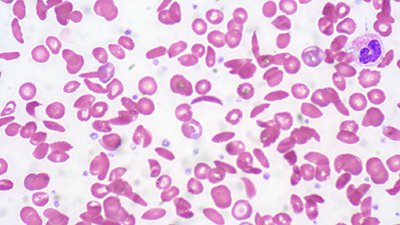 Sickle Cell Anemia and Other “Good” Mutations of Evolution