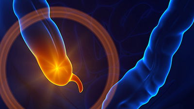 What If No One Had an Appendix?