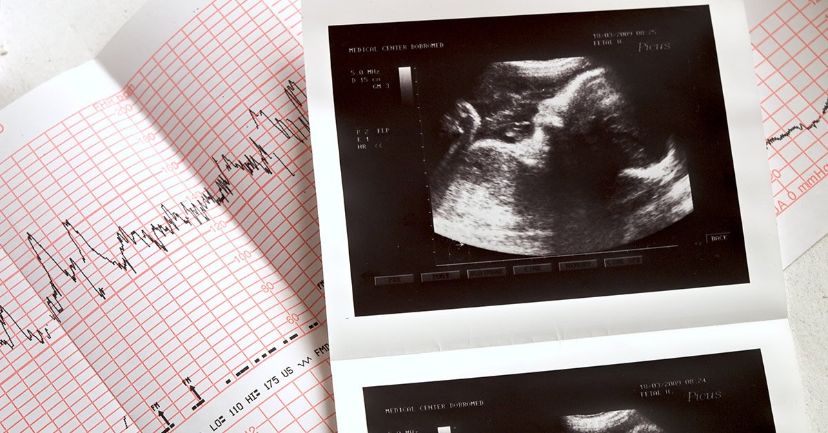 fetal heartbeat boy or girl